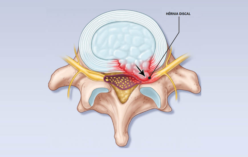 https://www.osteopatiadrcaioleal.com.br/blog/wp-content/uploads/2021/04/herniaDisco.jpg